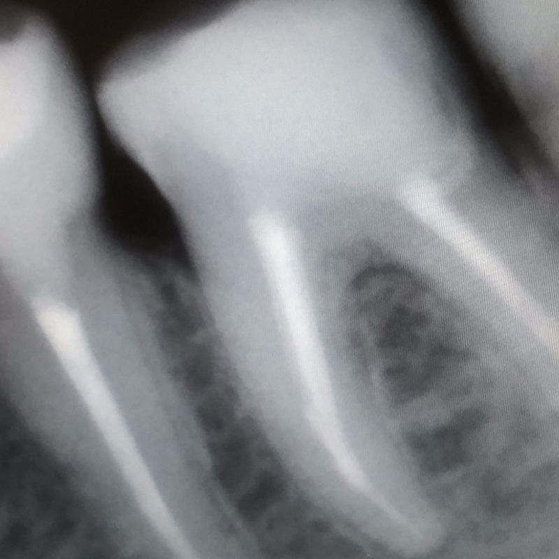 Фото 3.6 зуба после лечения 2