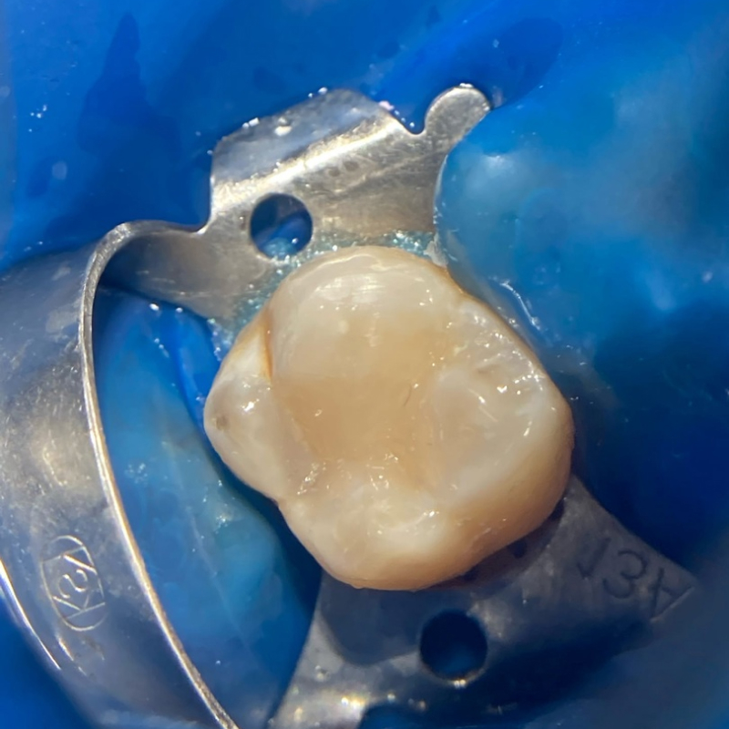 Фото зуба после установки пломбы 2