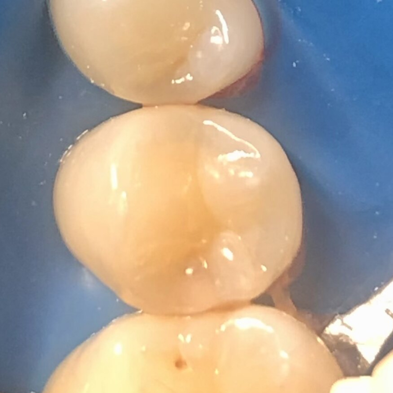 Фото зуба 4.5 после лечения кариеса 2