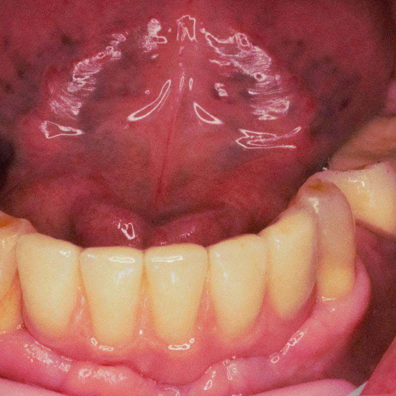 Фото имплантов на нижних зубах 1