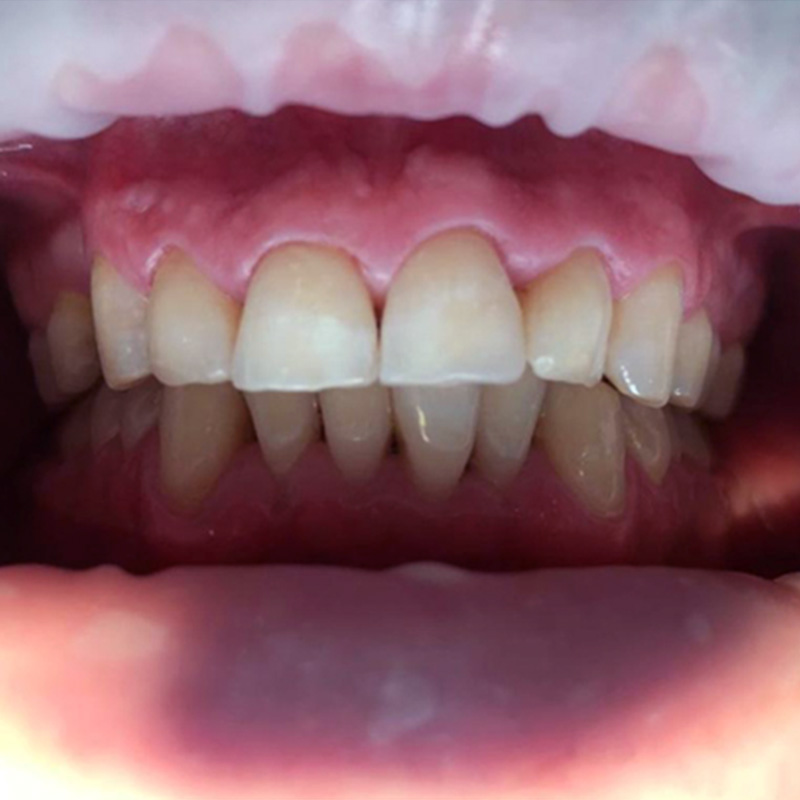 Фото переднего зуба после реставрации 2
