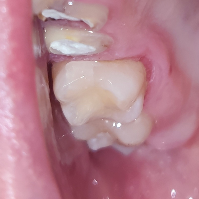 Зуб после лечения переднего кариеса 2