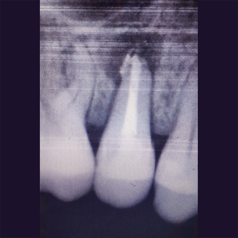 Снимок зубов после лечения периодонтита 2