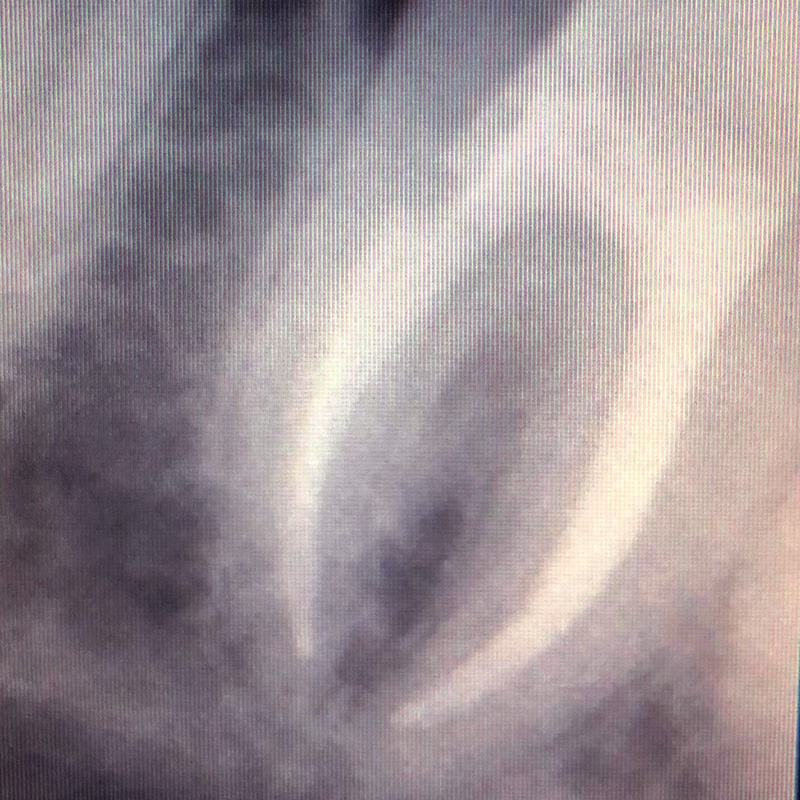Снимок после лечения пульпита зуба 2