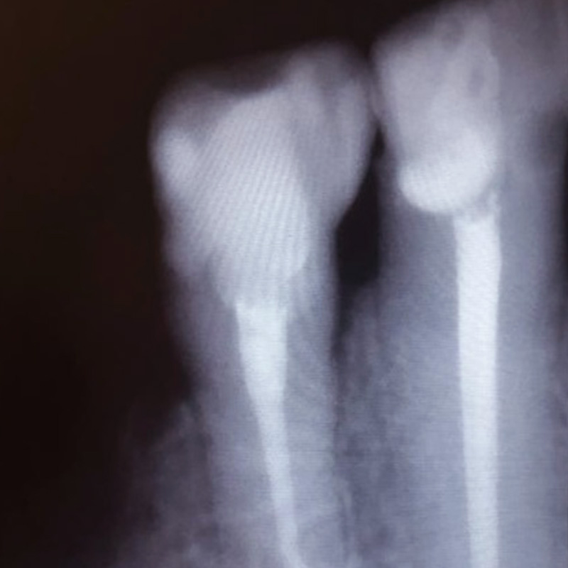 Фото зуба после лечения хронического пульпита 2