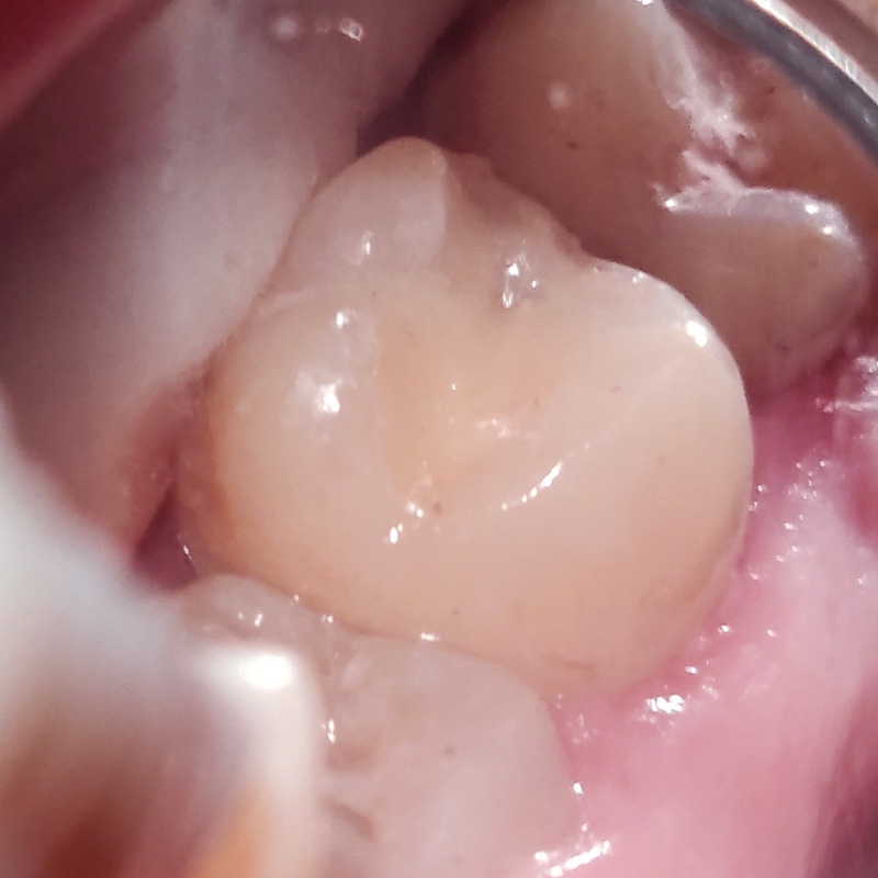 Зуб после лечения кариеса 2