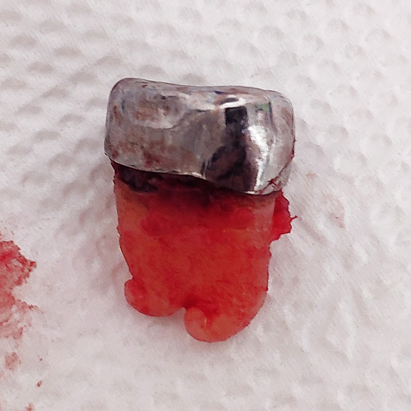 Удаленный зуб при обострении пульпита 2