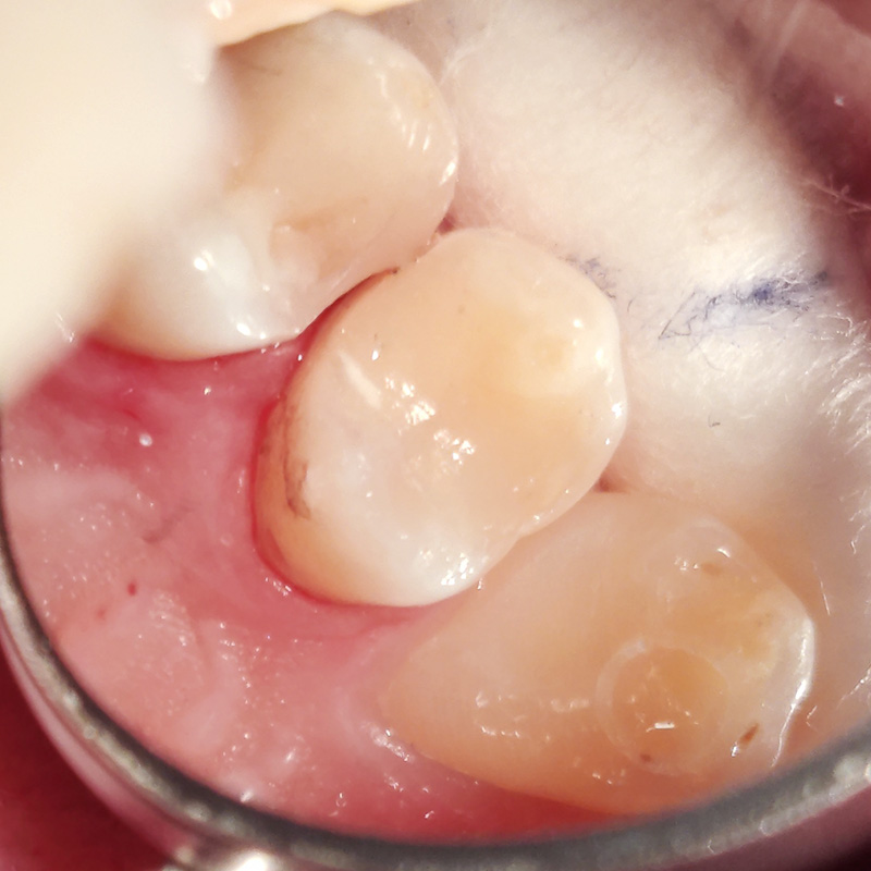 Фото зуба после лечения среднего кариеса 2