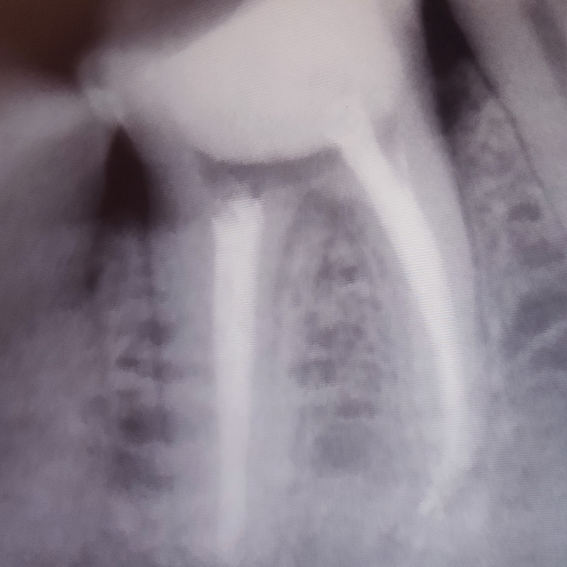 Снимок зуба после эндодонтического лечения 2