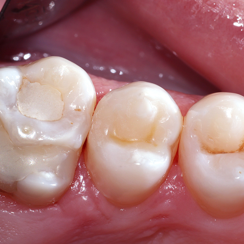 Восстановленный зуб 2