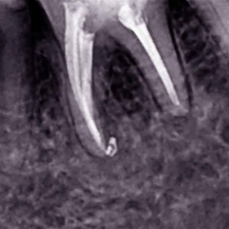 Снимок зуба после лечения периодонтита 2