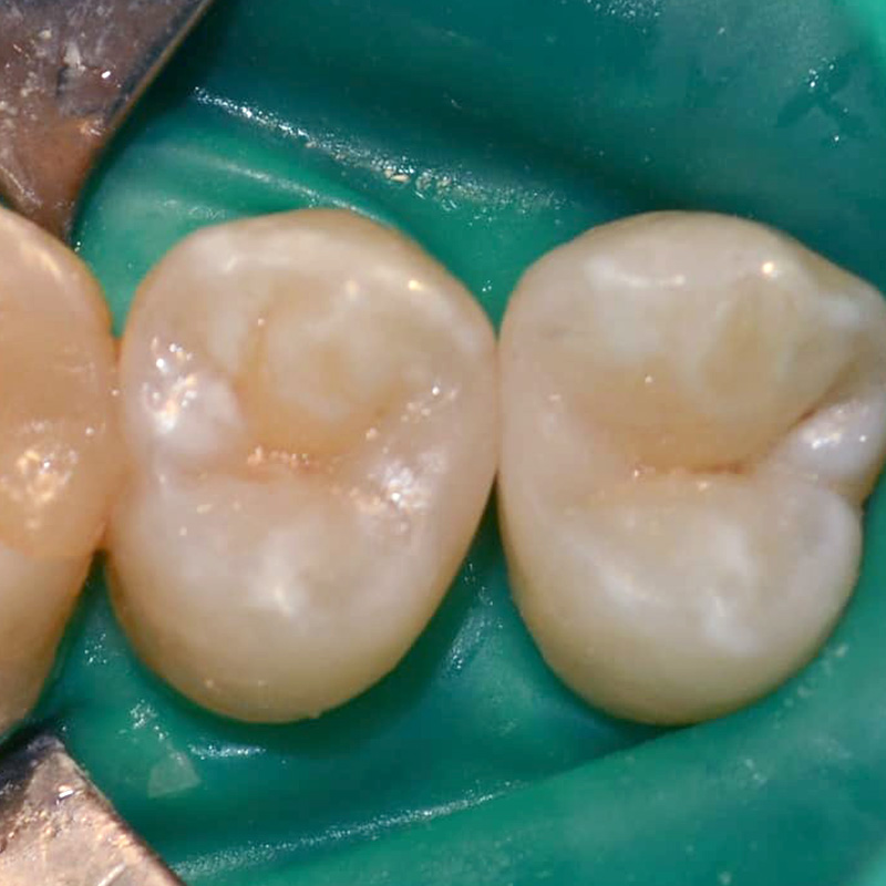 Фото кариеса зуба после лечения 2