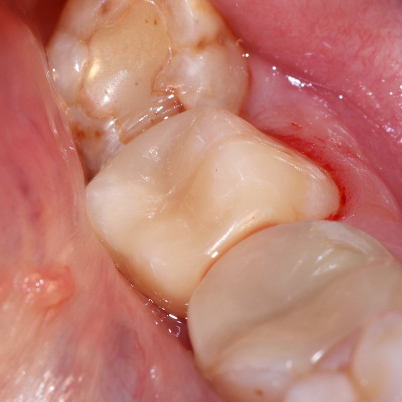 Фото зуба после лечения кариеса 2