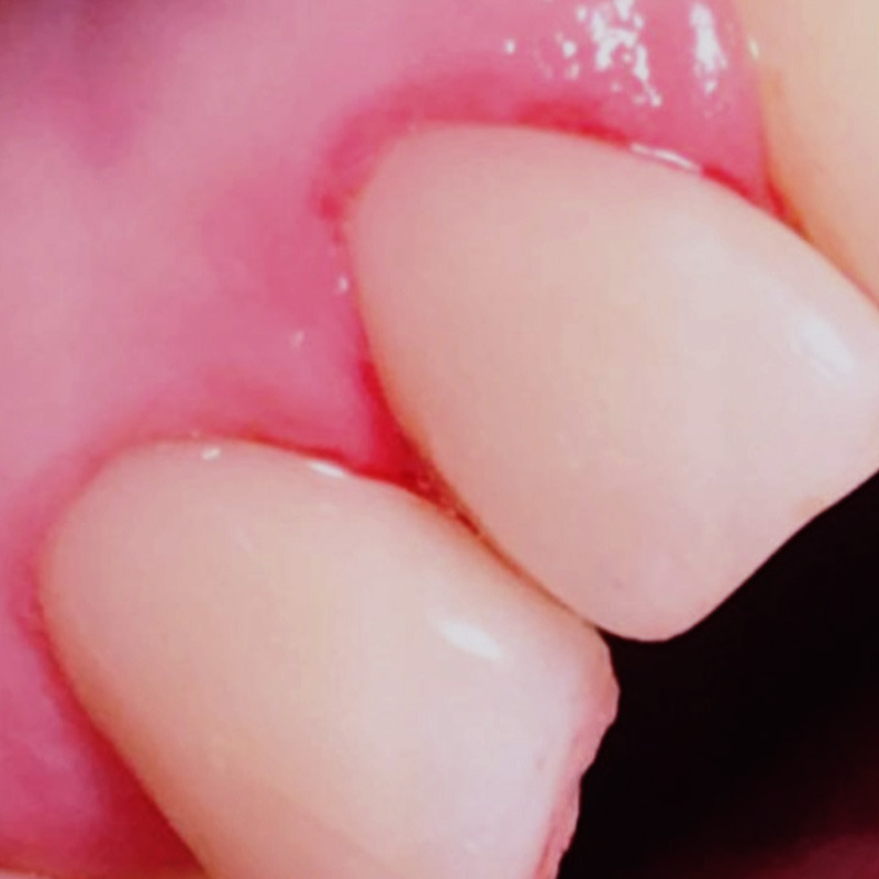 Передние зубы после лечения 2