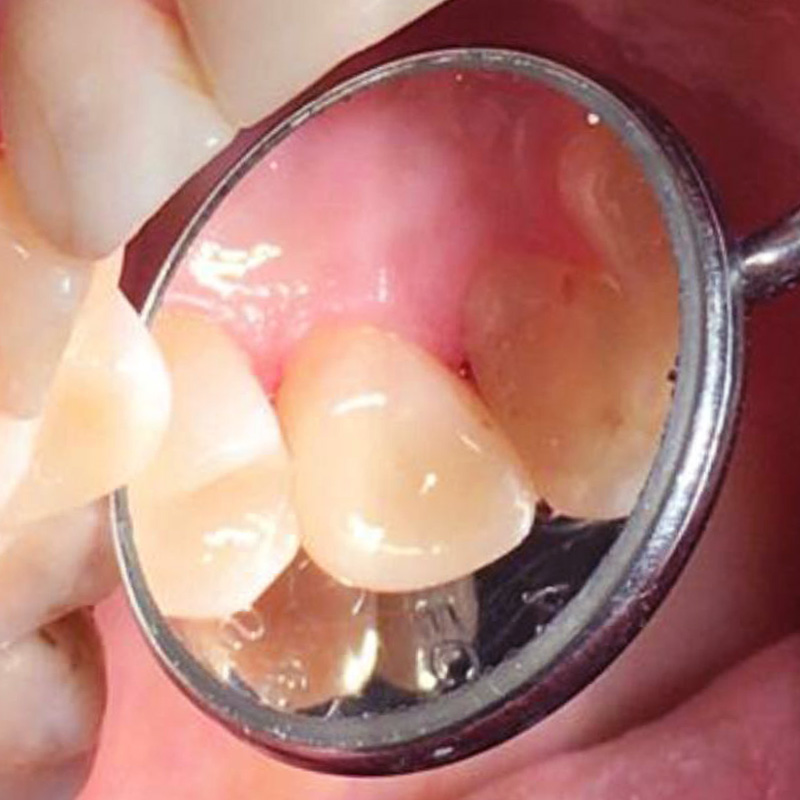 Фото переднего зуба после лечения 2