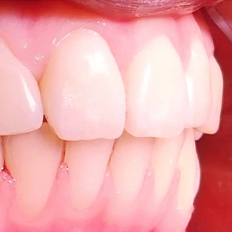 Фото скрученности зубов после лечения 1