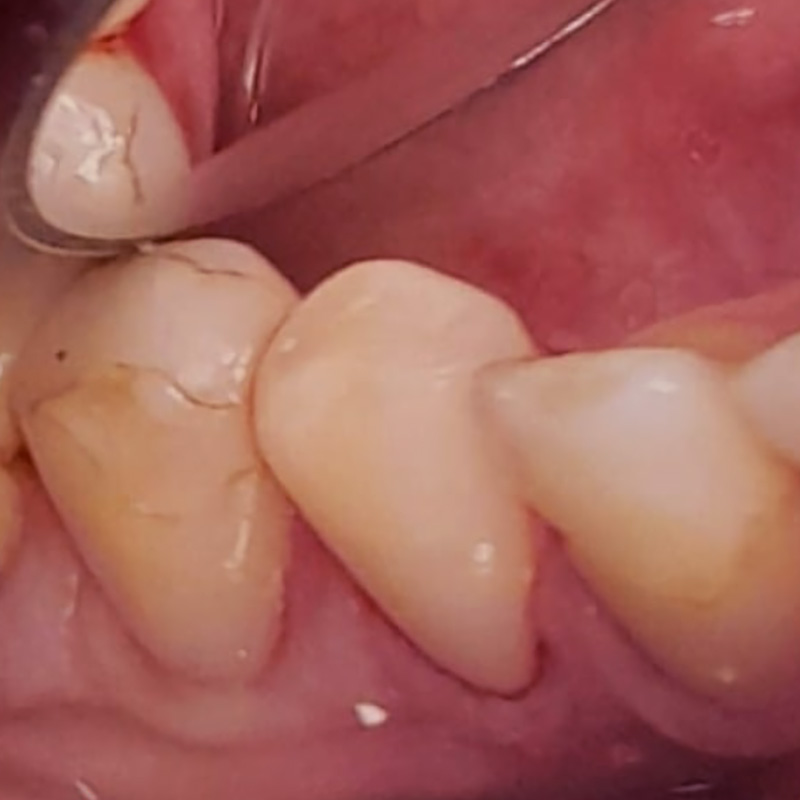 Фото зуба после лечения 2