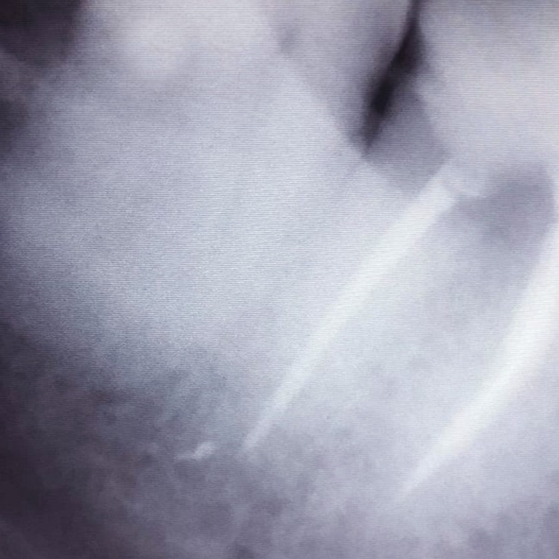 Фото после лечения пульпита 4.7 зуба 2