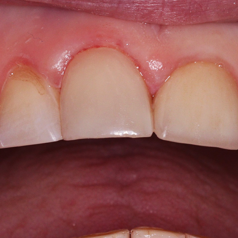 Фото зуба после устранения дисплазии 2