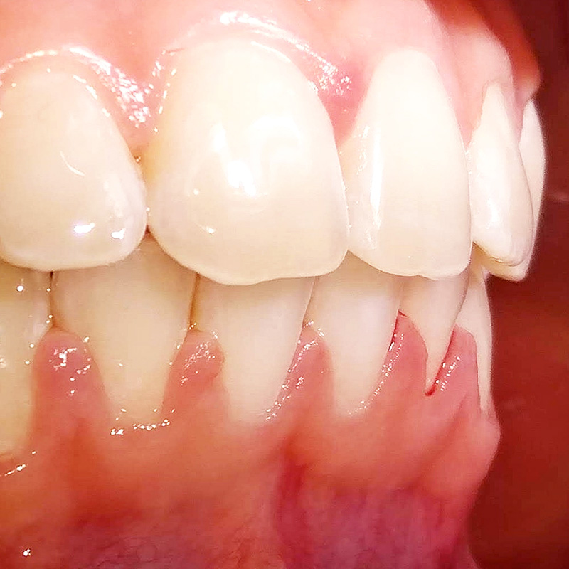 Фото зубов после установки брекетов 2