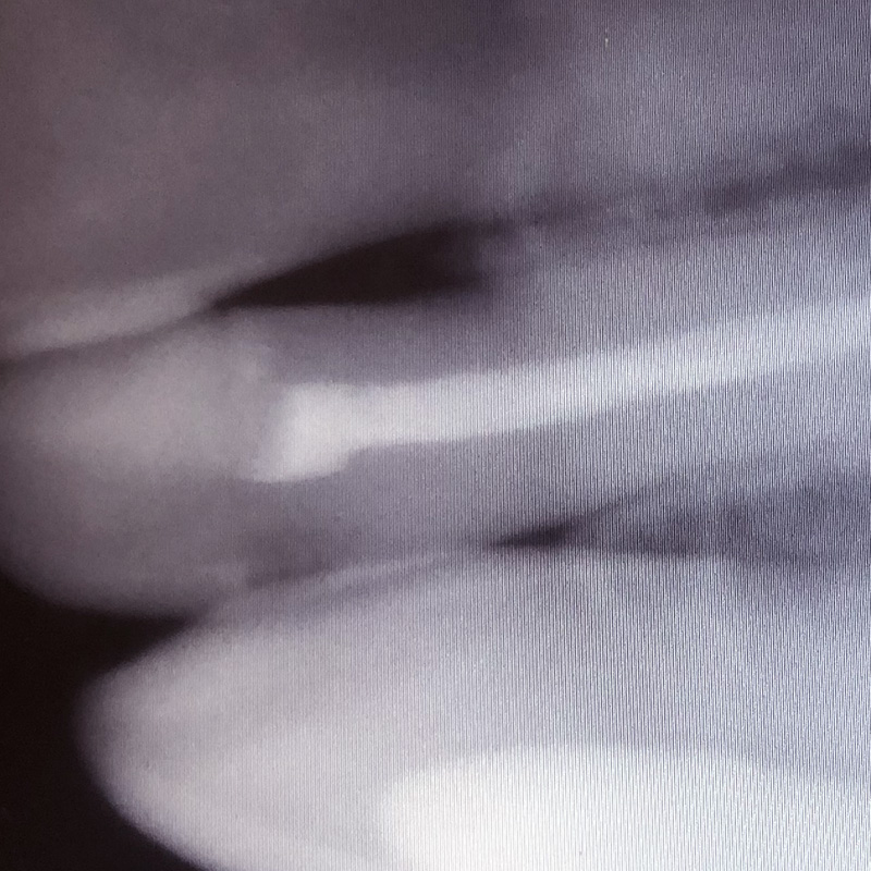 Снимок зуба после лечения хронического пульпита 2