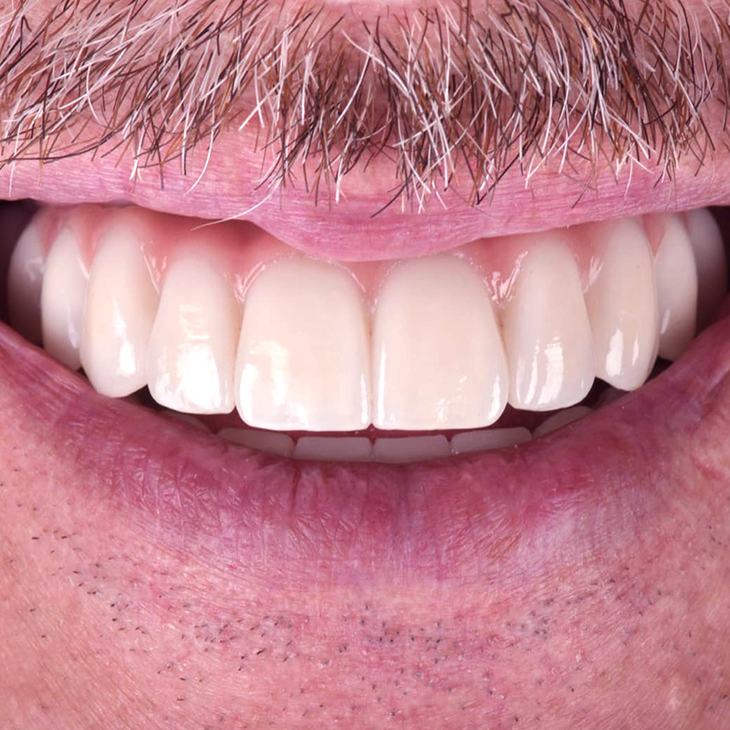 Фото зубов после имплантации