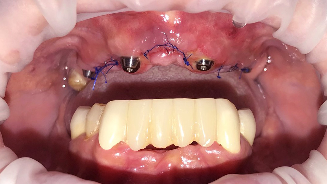 Зубной ряд до восстановления