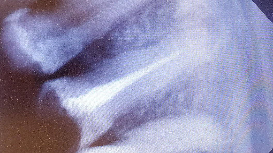 Фото до начала лечения зуба