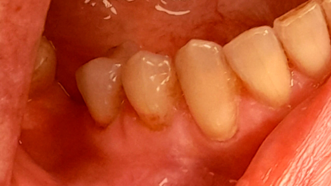 Фото 44 зуба с хроническим кариесом
