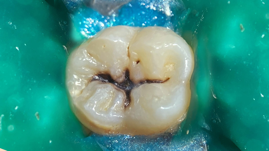 Фото зуба до лечения композитом