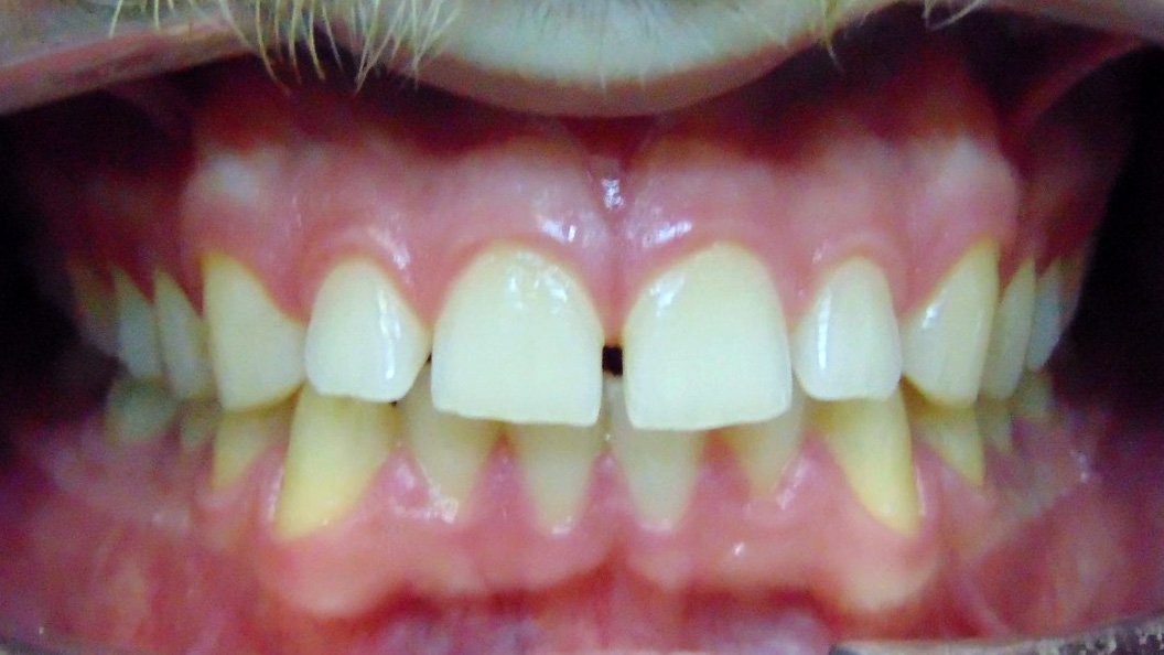 Фото зубов до лечения на элайнерах