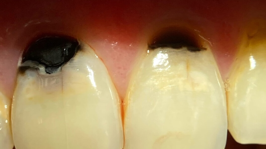 Фото зубов пораженного кариесом