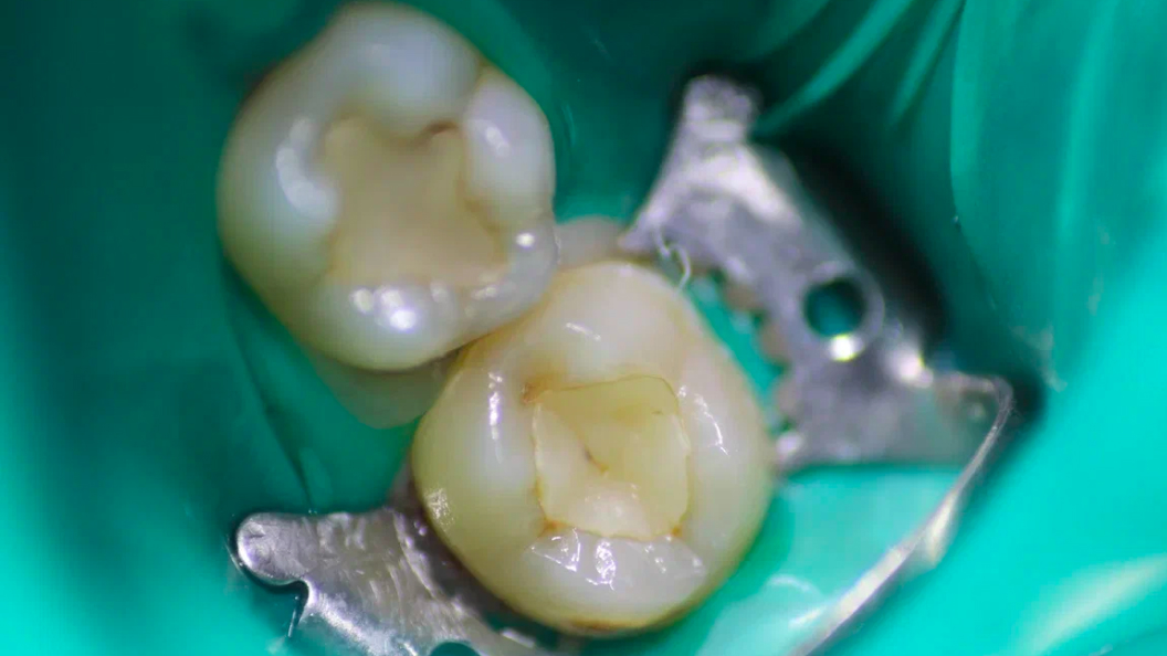 Фото зуба до лечения дентина
