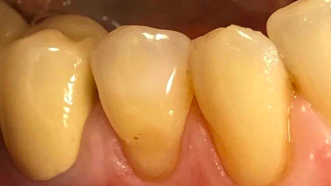 Фото зуба с клиновидным дефектом