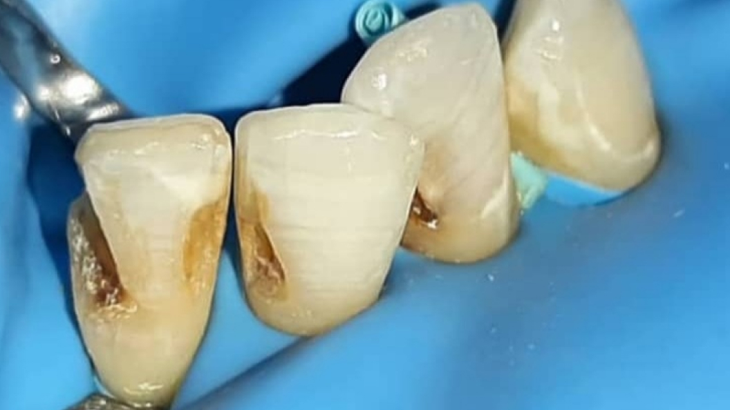 Фото кариеса 3-х зубов до лечения