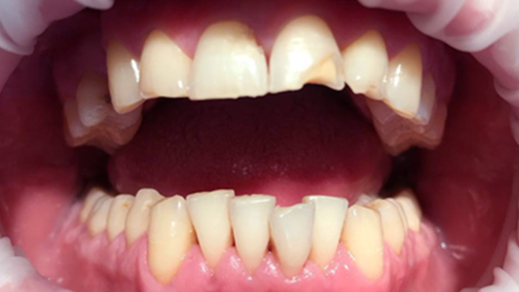 Фото переднего зуба до реставрации