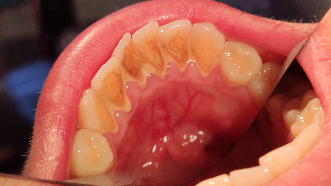 Зубы до удаления зубных отложений