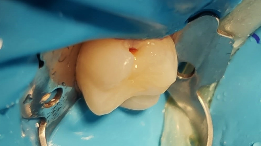 Зуб до лечения переднего кариеса