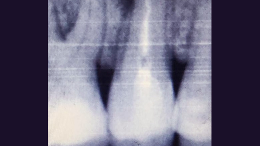 Снимок зубов до лечения периодонтита