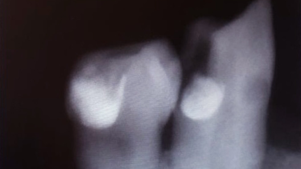 Фото зуба с хроническим пульпитом