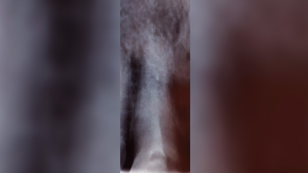 Снимок зуба с фиброзным периодонтитом