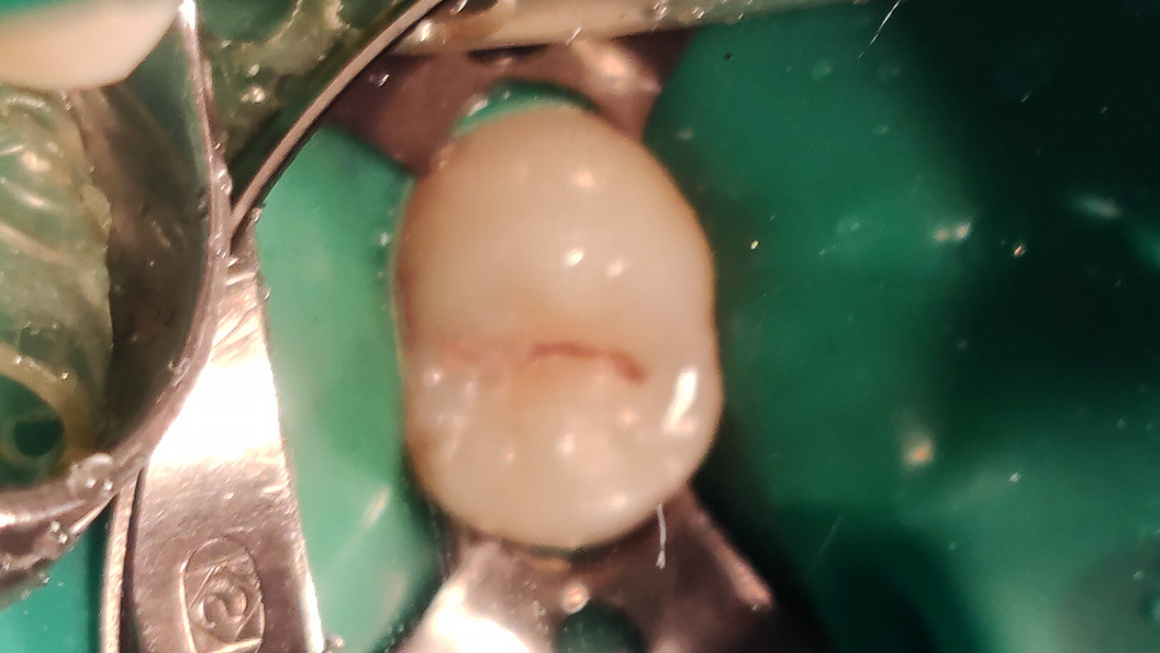 Фото зуба до лечения кариеса