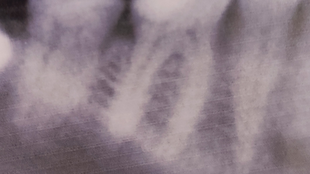 Снимок зуба до эндодонтического лечения