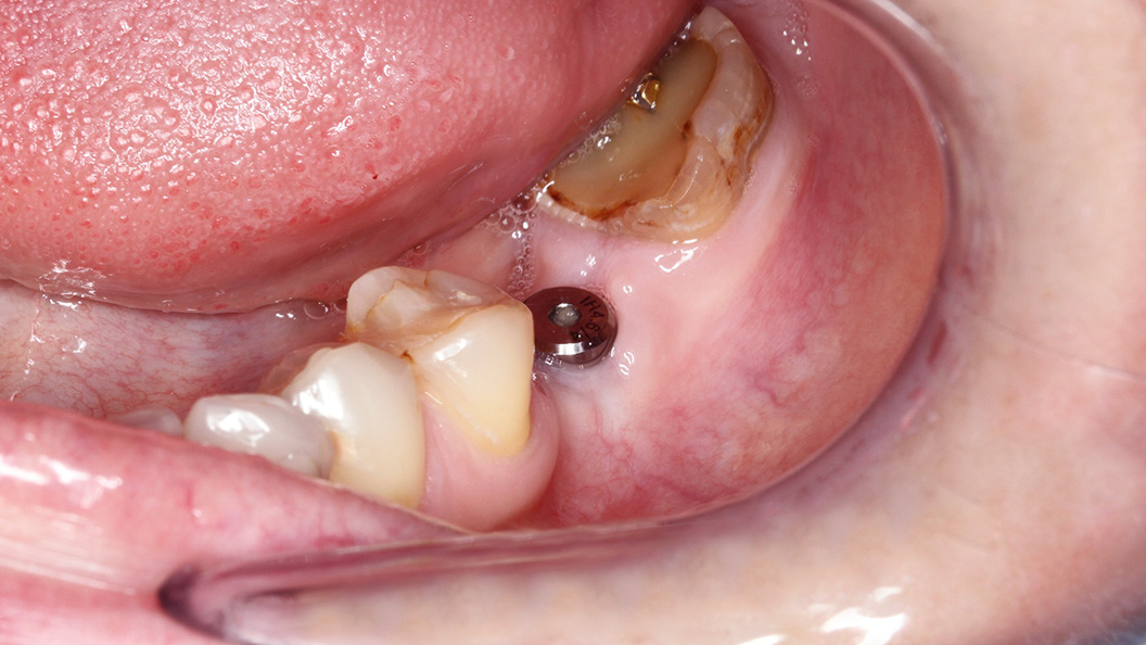 Фото импланта одного зуба