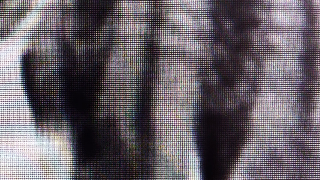 Снимок фиброзного периодонтита