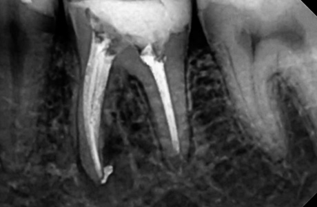 Снимок зуба до лечения периодонтита