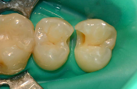 Фото кариеса зуба до лечения