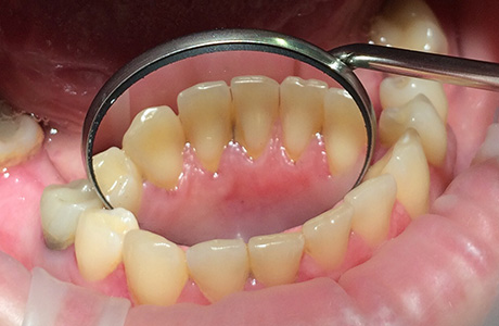 Зубы до чистки и осветления эмали