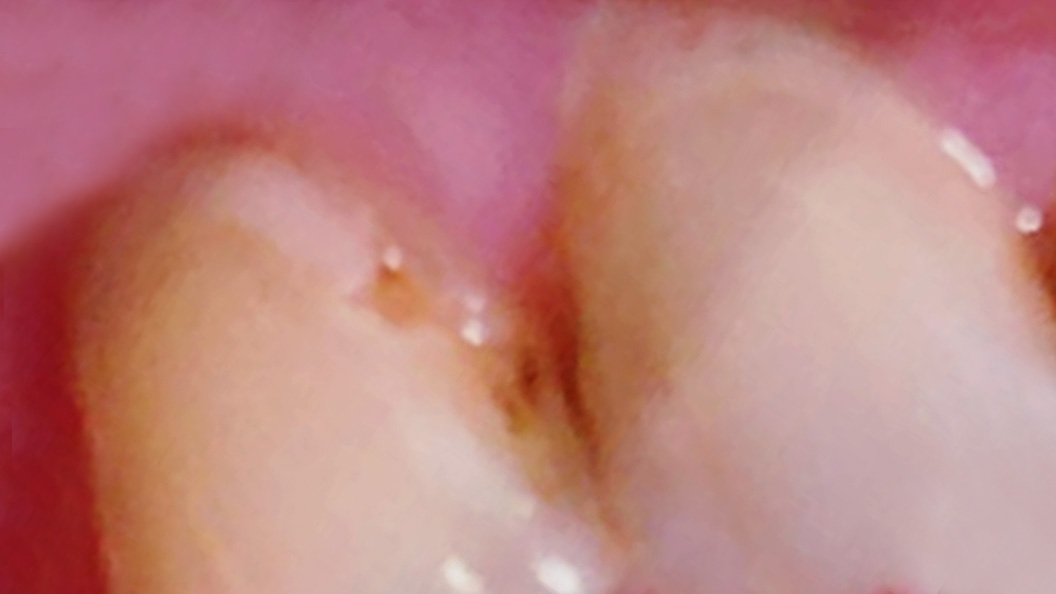 Фото передних зубов с кариесом