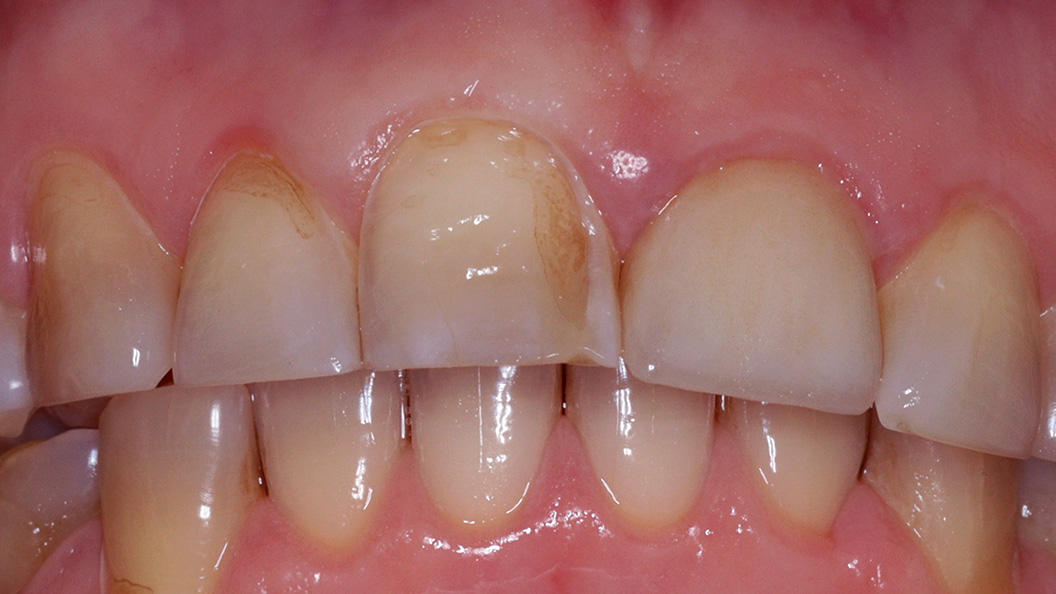 Фото дисплазии эмали переднего зуба